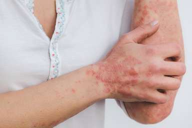 Hautkrankheiten in der Heilpraktiker-Praxis Haut & Hautkrankheiten: Neurodermitis, Schuppenflechte (Psoriasis) & mehr