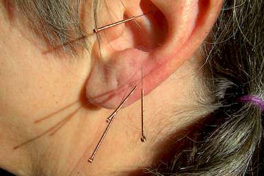 Ausbildung Ohrakupunktur: das Ohr als Spiegel des Körpers